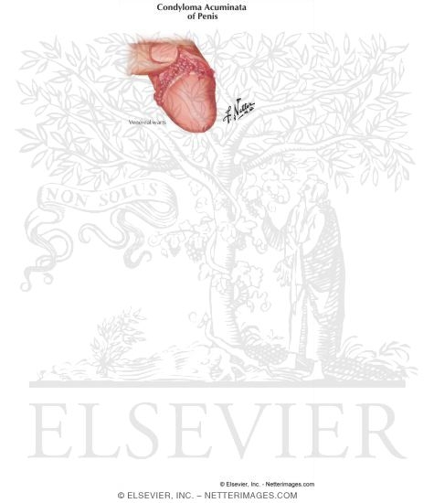 Watermarked preview of labeled image: Condyloma Acuminata of Penis