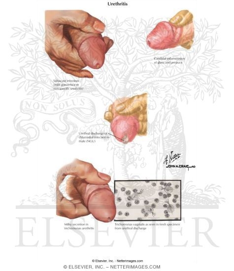 Watermarked preview of labeled image: Urethritis