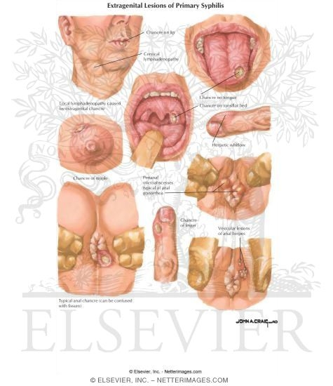 Extragenital Lesions