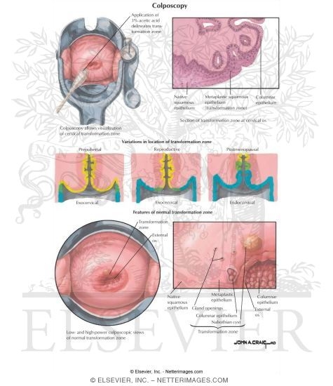 Watermarked preview of labeled image: Colposcopy
Variations in Location of Transformation Zone