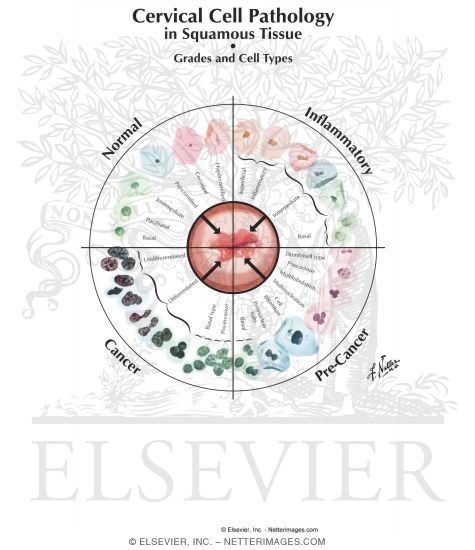 Watermarked preview of labeled image: Abnormal Pap Smear: ASCUS or AGCUS
Cervical Cell Pathology in Squamous Tissue