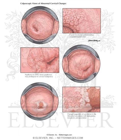 Colposcopic Views of Abnormal Cervical Changes
Carcinoma in Situ (Cervix)