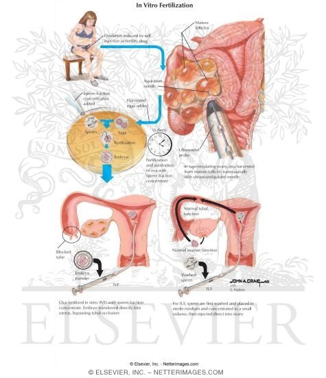 Watermarked preview of labeled image: In Vitro Fertilization