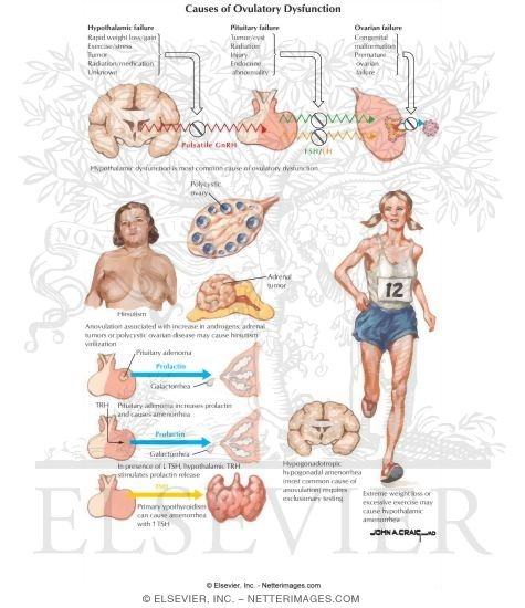 Watermarked preview of labeled image: Causes of Ovulatory Dysfunction