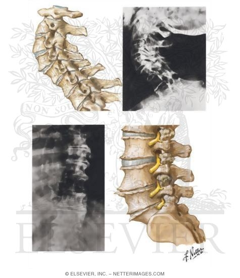 Watermarked preview of unlabeled image: Spine Involvement In Osteoarthritis