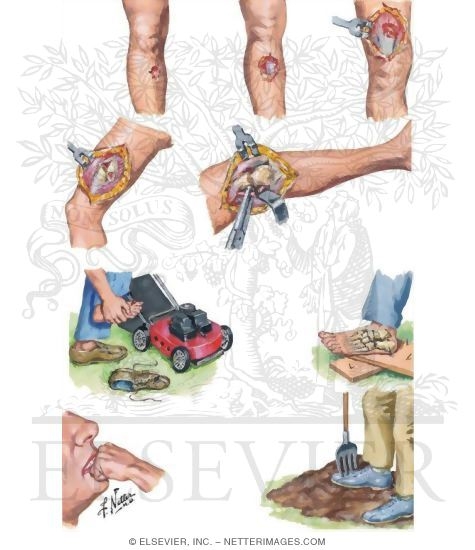 Watermarked preview of unlabeled image: Musculoskeletal Injuries By Anatomic Site: Fracture Complications
