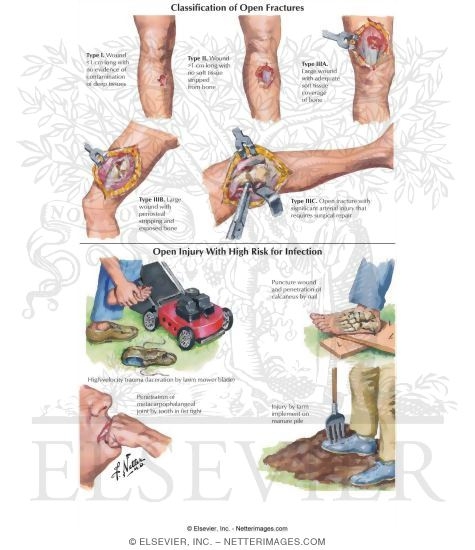 Watermarked preview of labeled image: Musculoskeletal Injuries By Anatomic Site: Fracture Complications