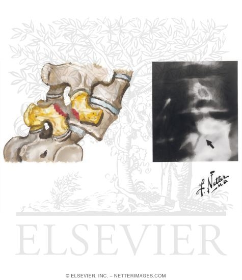 Watermarked preview of unlabeled image: Spondylolysis and Spondylolisthesis