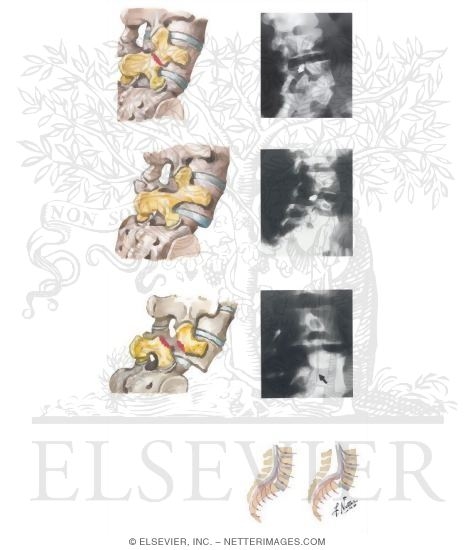 Watermarked preview of unlabeled image: Spondylolysis and Spondylolisthesis