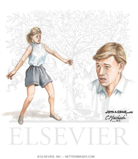 Watermarked preview of unlabeled image: Focal Neurologic Phenomena