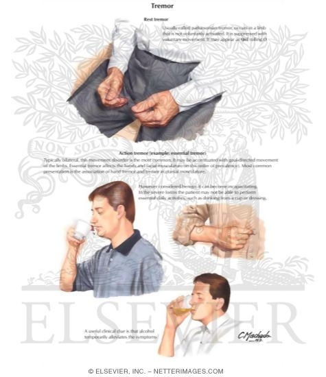 Watermarked preview of labeled image: Tremor