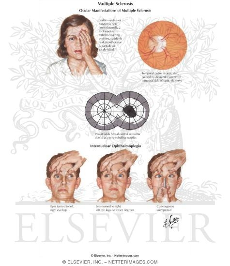 Multiple Sclerosis: Ocular Manifestations of Multiple Sclerosis