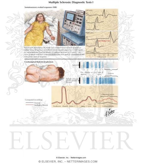 Watermarked preview of labeled image: Multiple Sclerosis: Diagnostic Tests