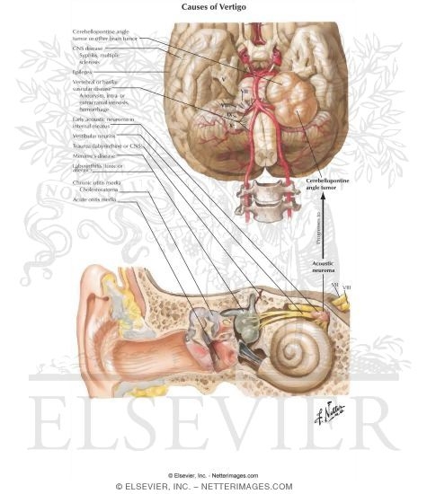 Watermarked preview of labeled image: The Many Pathologic Causes of Vertigo