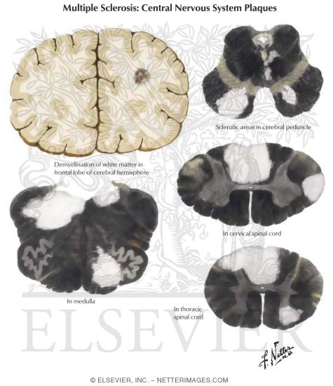 Watermarked preview of labeled image: Multiple Sclerosis: Central Nervous System Pathology