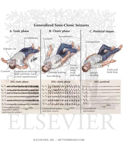 Generalized Tonic Clonic Seizures