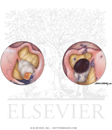 Endometriosis: Laparoscopic Views