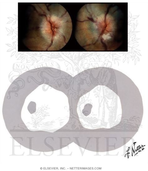 Watermarked preview of unlabeled image: Effects of Increased Intracranial Pressure On Optic Disk and Visual Fields