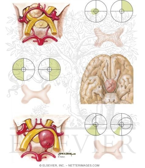 Disorders Affecting Optic Chiasm