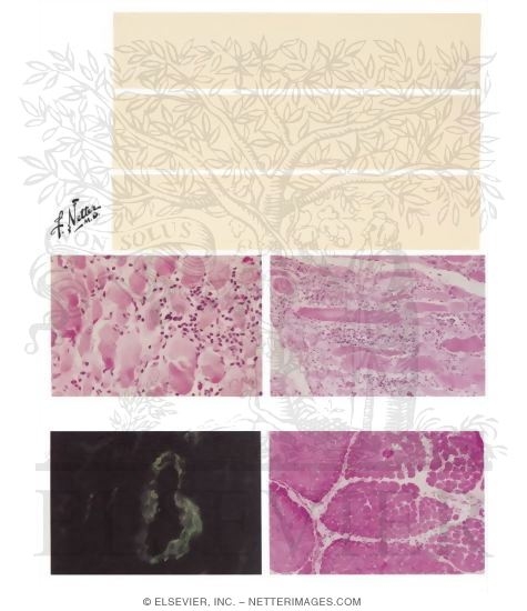 Polymyositis and Dermatomyositis