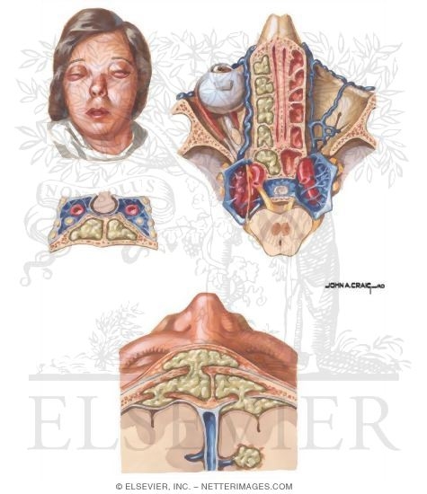 Watermarked preview of unlabeled image: Intracranial Complications