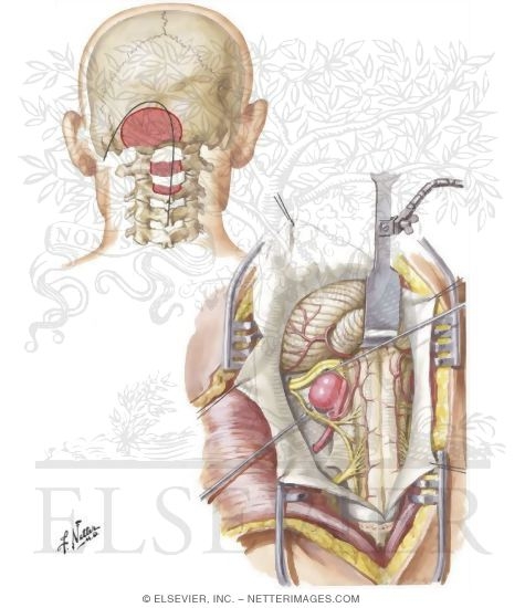 Watermarked preview of unlabeled image: Posterior Approach for Vertebral and Posterior Inferior Cerebellar Aneurysms