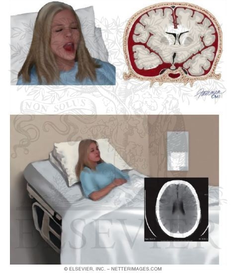 Persistent Vegetative State