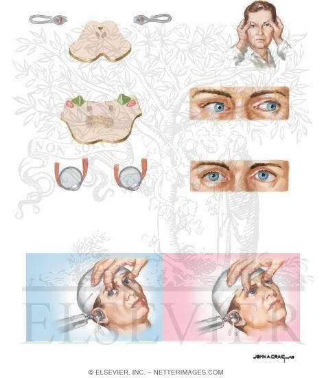 Eye Movements With Increased ICP