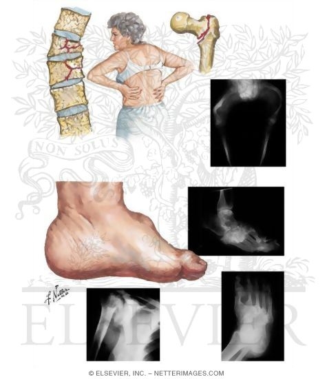 Pathologic Fracture