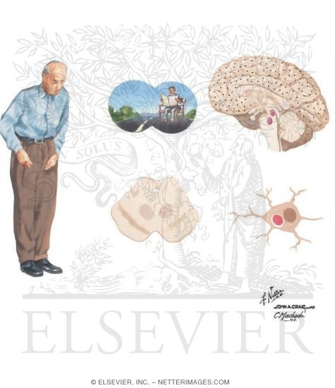 Watermarked preview of unlabeled image: Dementia With Lewy Bodies