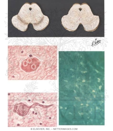 Neuropathy of Parkinson's Disease