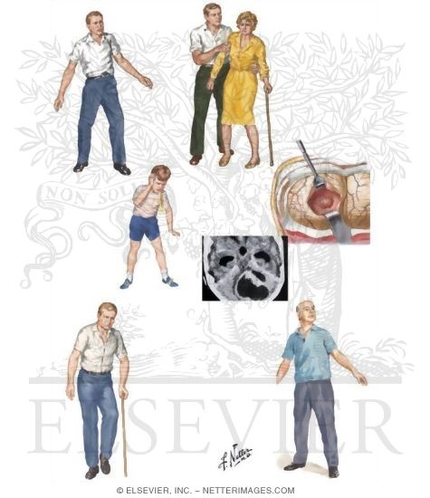 Watermarked preview of unlabeled image: Neurodegenerative Disorders