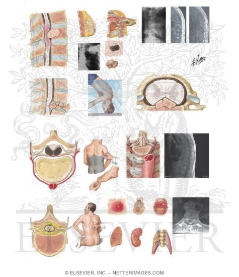 Watermarked preview of unlabeled image: Acute Spinal Cord Syndromes: Pathology, Etiology, and Diagnosis