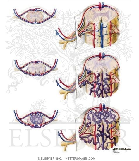 Spinal Arteriovenous Malformations (AVMs)