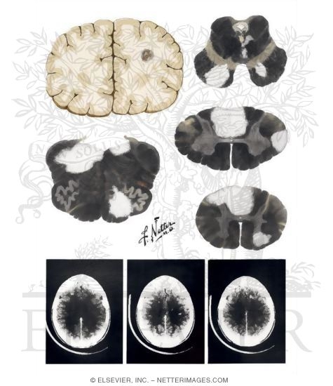 Watermarked preview of unlabeled image: Multiple Sclerosis: Central Nervous System Pathology