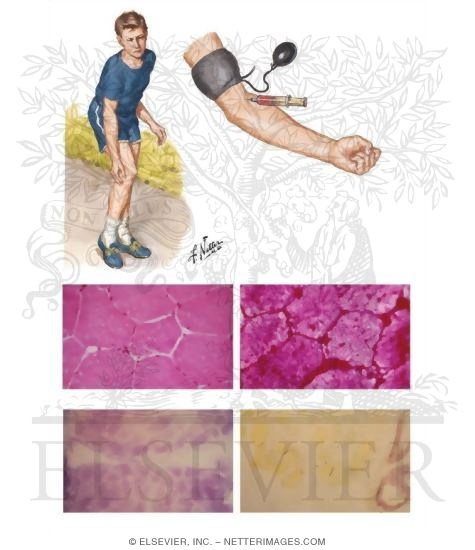McArdle Disease