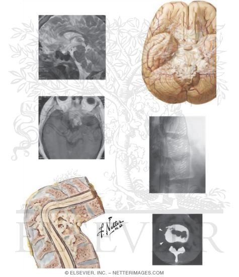 Watermarked preview of unlabeled image: Tuberculosis of Brain and Spine