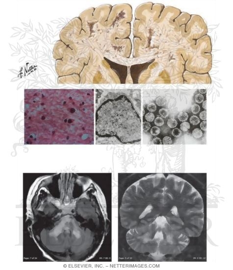Slow Virus Infections