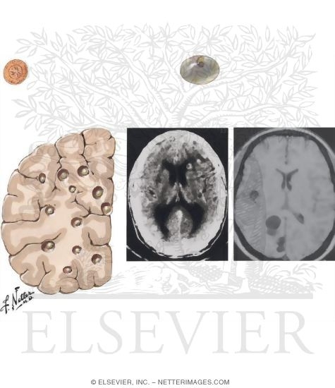 Watermarked preview of unlabeled image: Cysticercosis