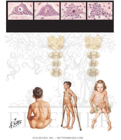 Watermarked preview of unlabeled image: Poliomyelitis