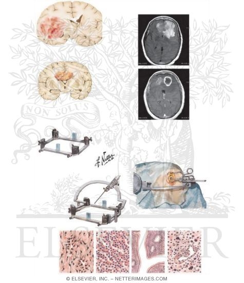 Watermarked preview of unlabeled image: Gliomas