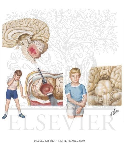 Brain Tumors In Children