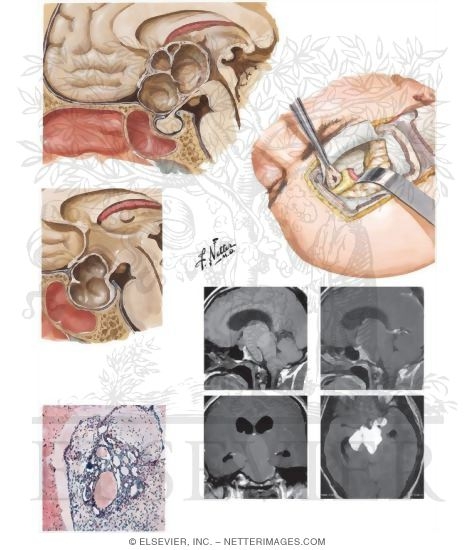 Watermarked preview of unlabeled image: Craniopharyngiomas