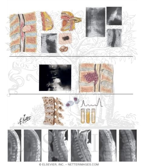 Watermarked preview of unlabeled image: Extradural Spinal Tumors