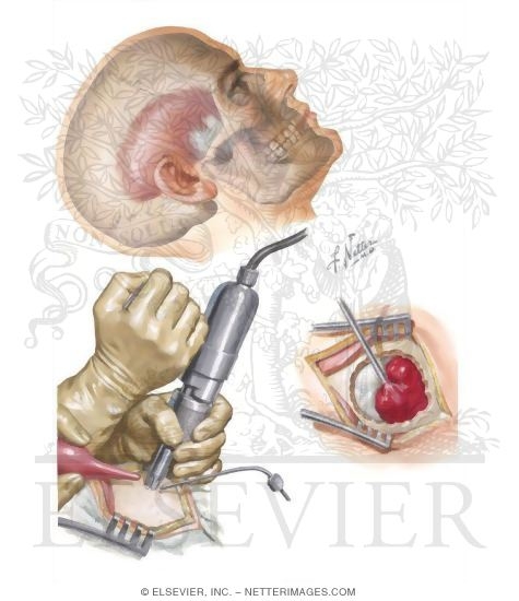 Watermarked preview of unlabeled image: Exploratory Burr Holes and Removal of Posterior Fossa Hematoma