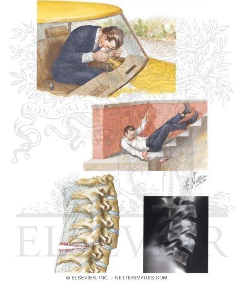 Cervical Spine Injury: Flexion and Flexion-Rotation