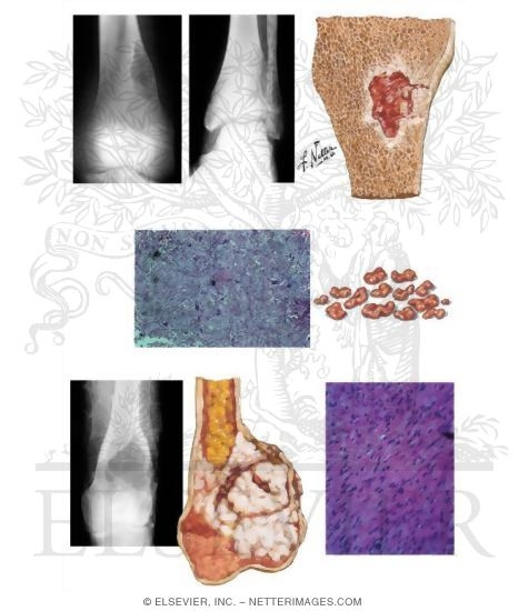 Nonossifying Fibroma
Desmoplastic Fibroma