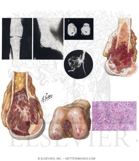 Watermarked preview of unlabeled image: Giant-Cell Tumor of Bone