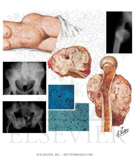 Chondrosarcoma
