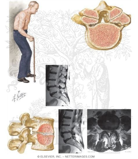 Watermarked preview of unlabeled image: Spondylotic Subluxation With High-Grade Stenosis